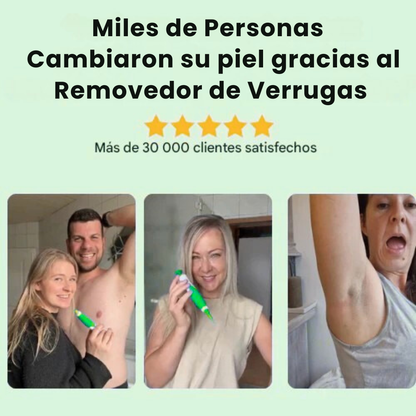 Removedor de Verrugas Profecional