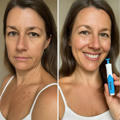 Removedor de Verrugas Profecional