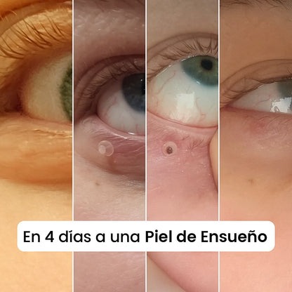 Removedor de Verrugas Profecional