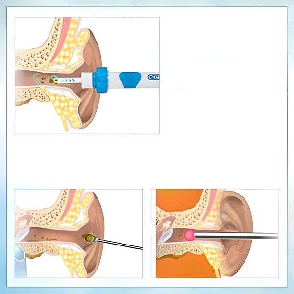 Limpiador Profecional de Cerilla