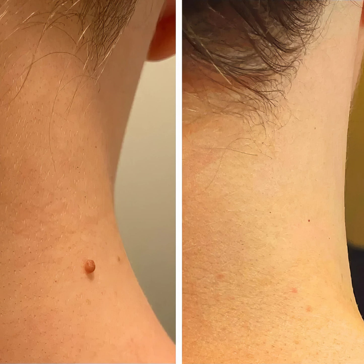 Removedor de Verrugas Profecional