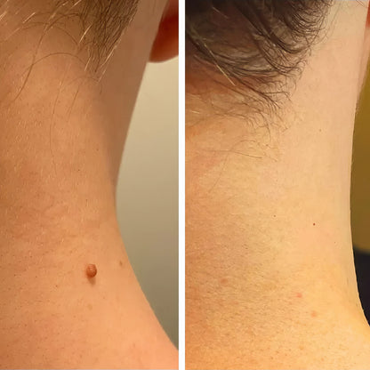 Removedor de Verrugas Profecional